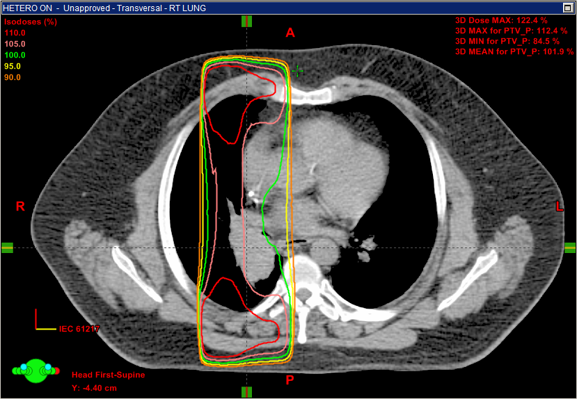 Inhomogeneity Correction ON