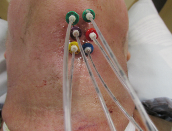 Interstitial brachytherapy catheters for base of tongue treatment