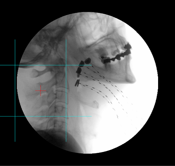 X-ray image of dummy wires inserted into interstitial brachytherapy catheters for base of tongue treatment