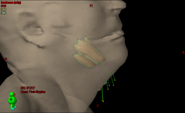 3D rendering of completed HDR base of tongue boost plan